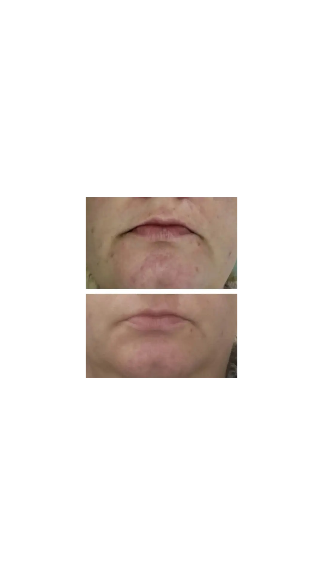 Chin acne before and after