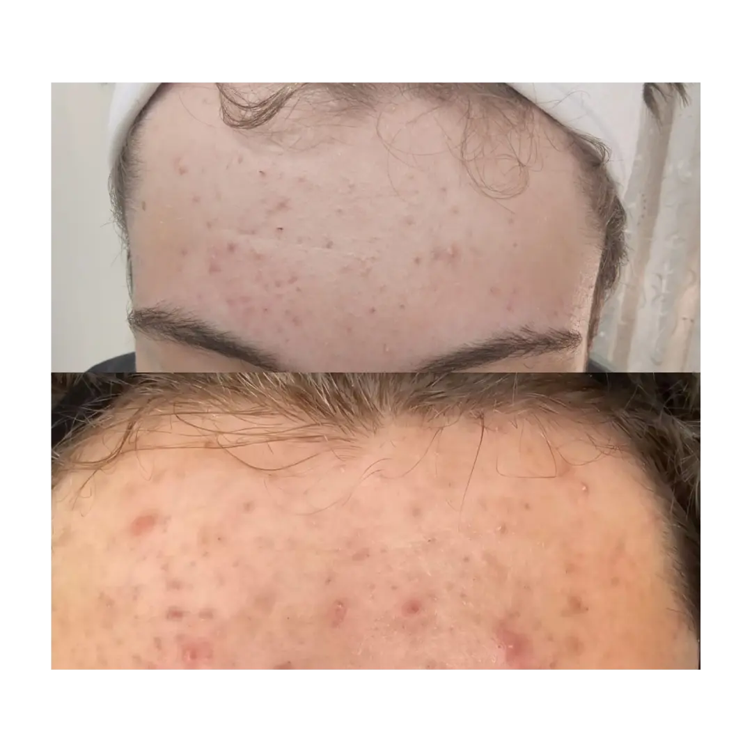 Acne and congestion before and after