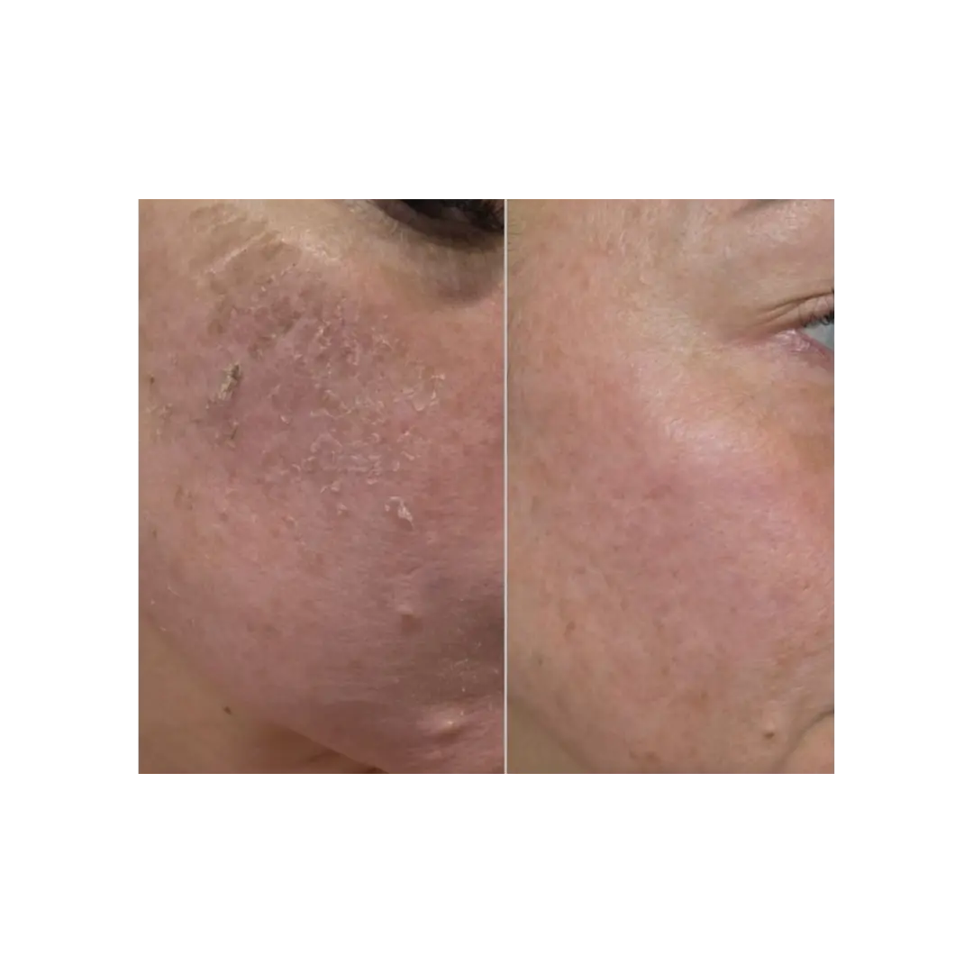 Pigmentation treatment before and after