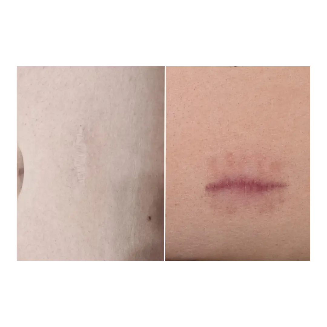 Skin rejuvenation before and after