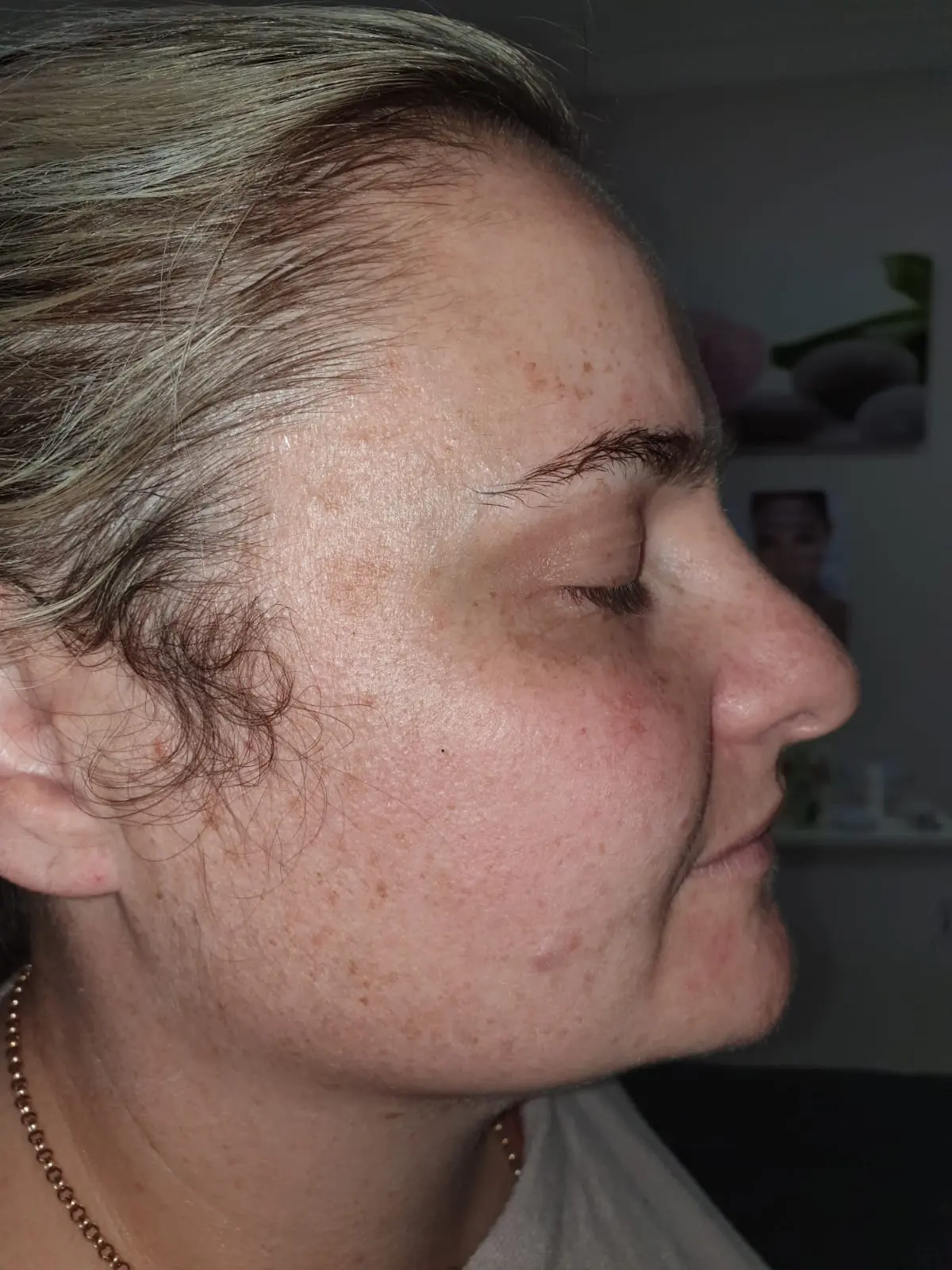 Pigmentation after treatment