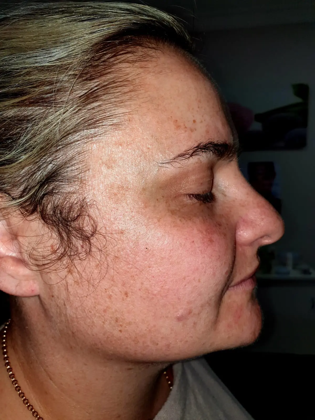 Pigmentation before treatment