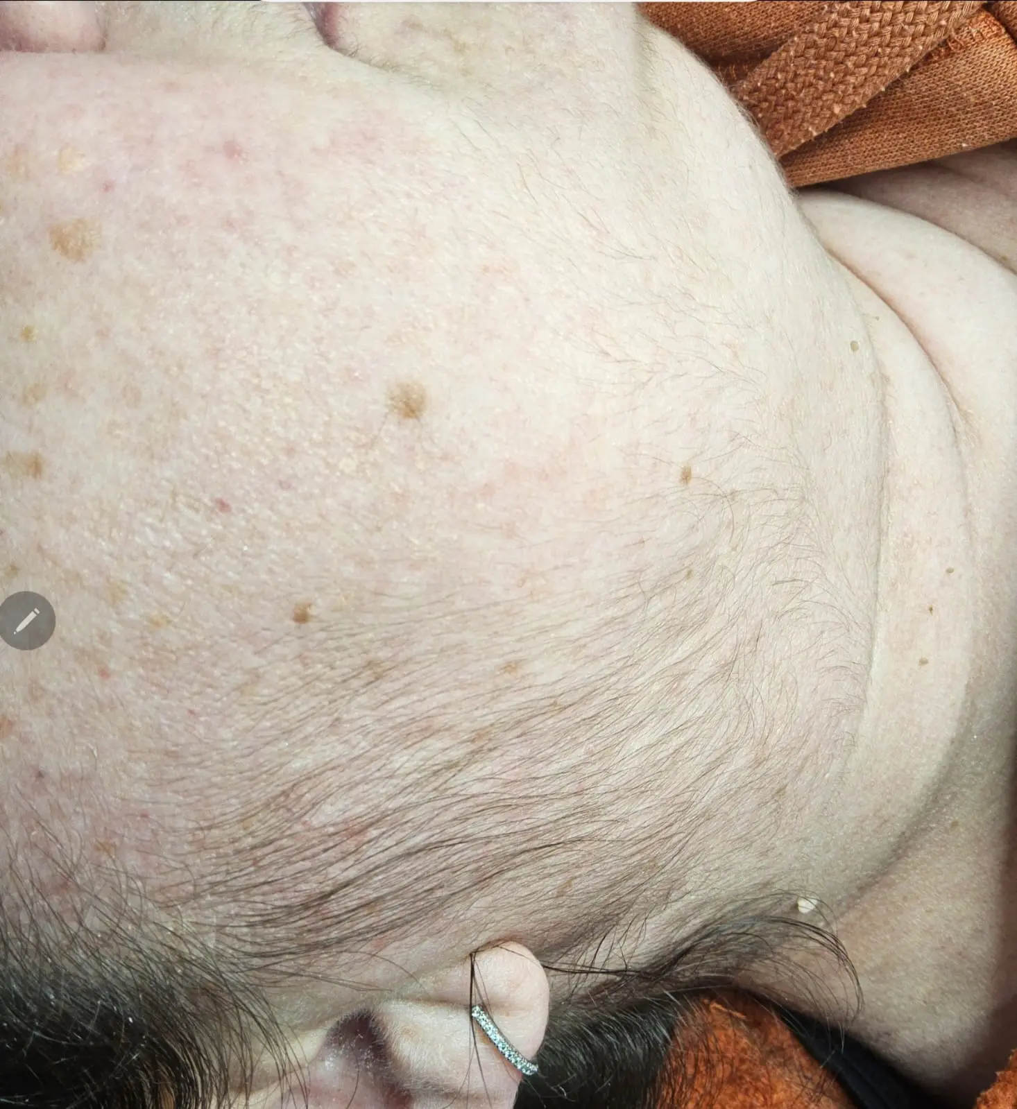 Cheek pigmentation closeup