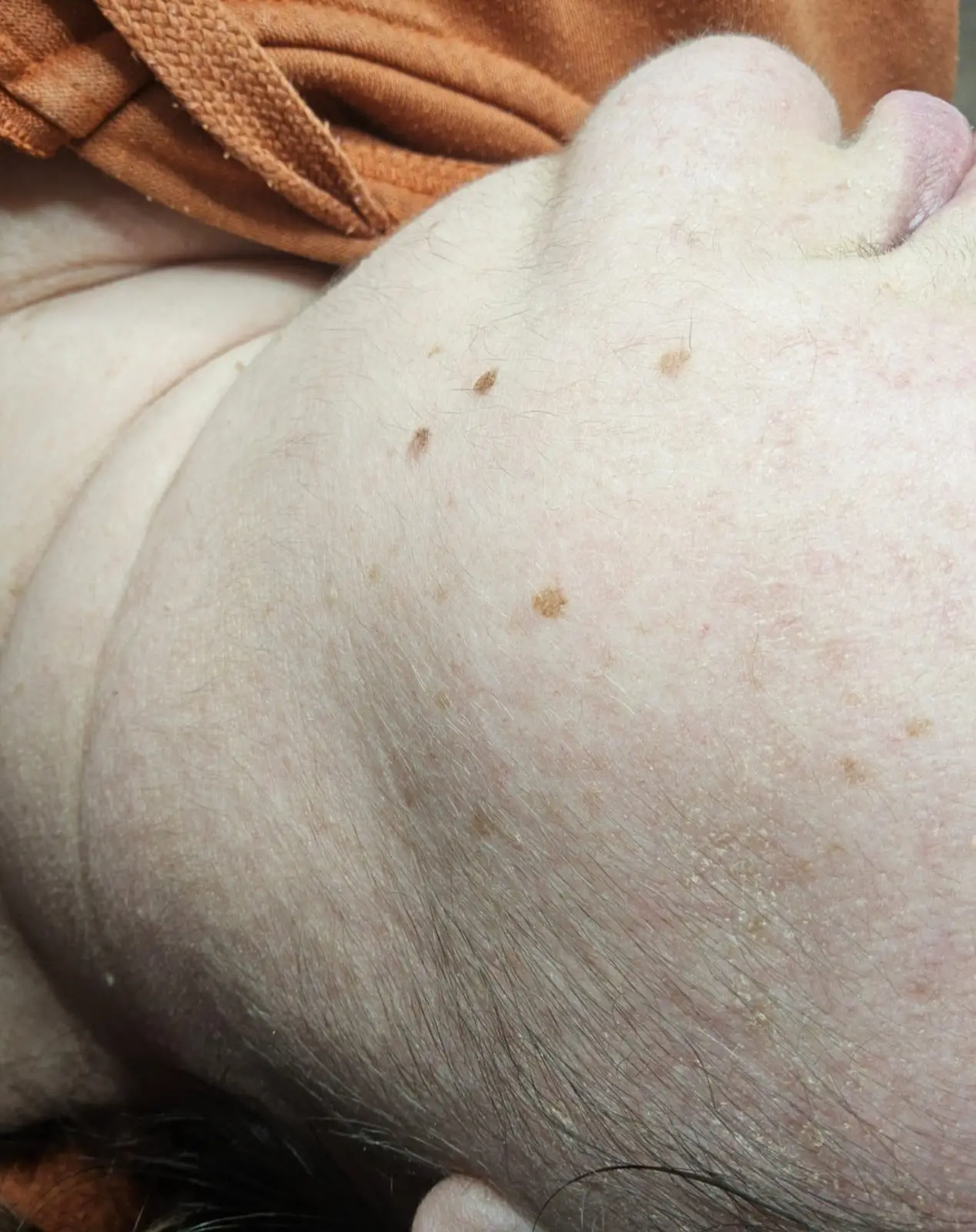 Décolletage pigmentation treatment