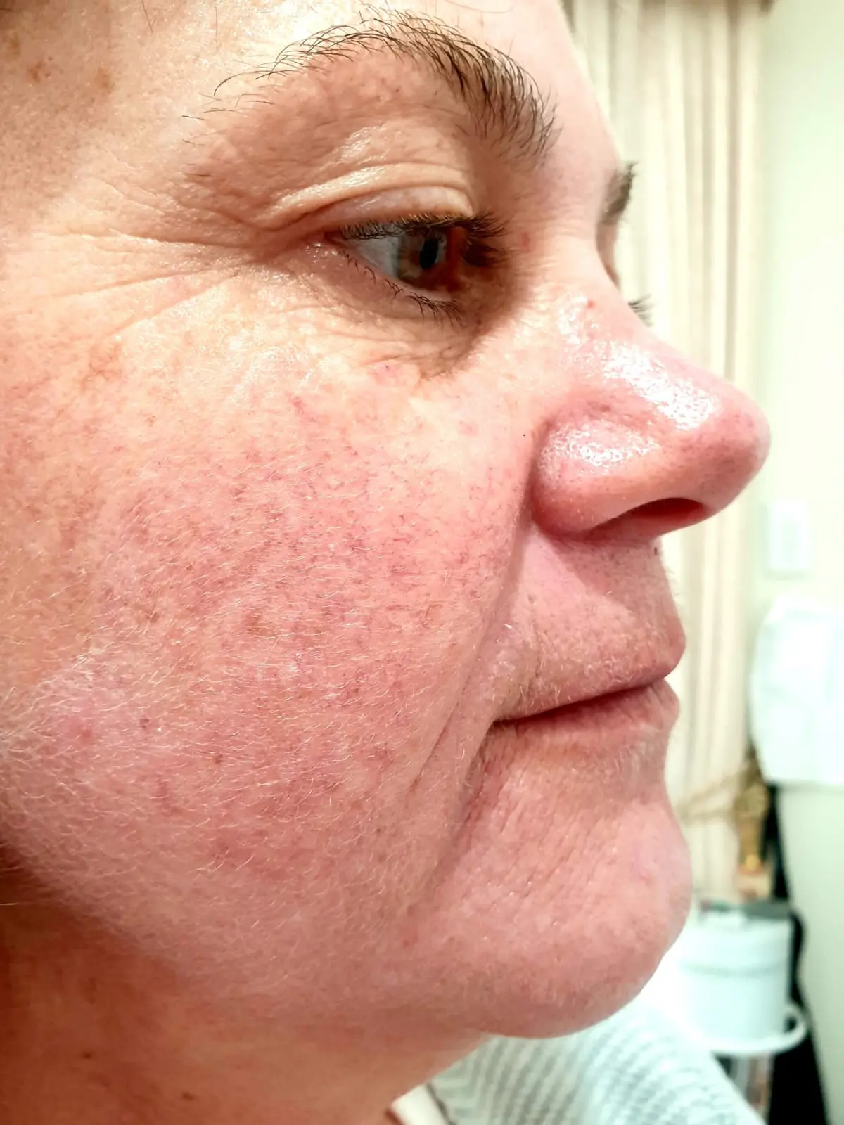 Rosacea after treatment