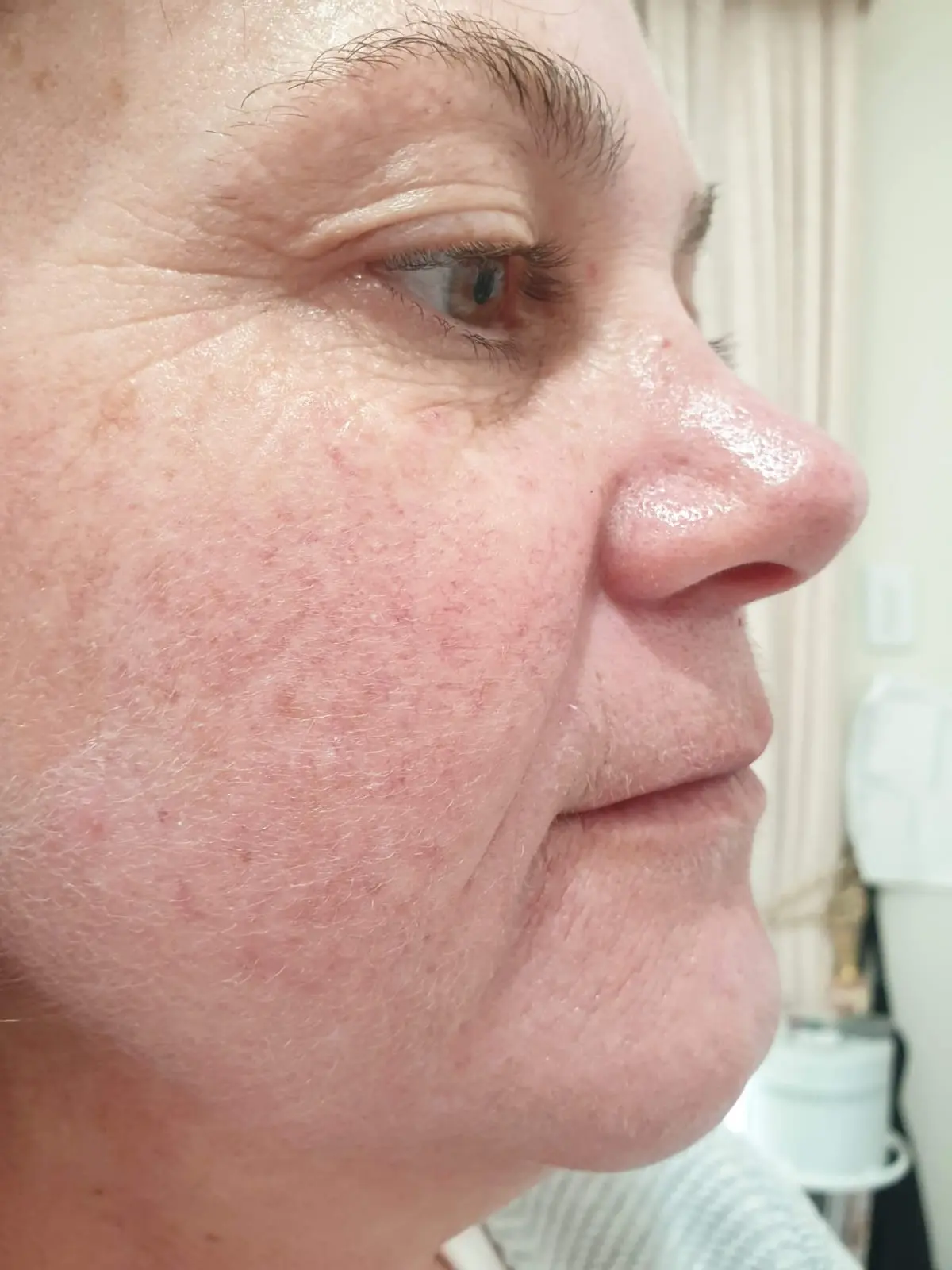 Rosacea before treatment
