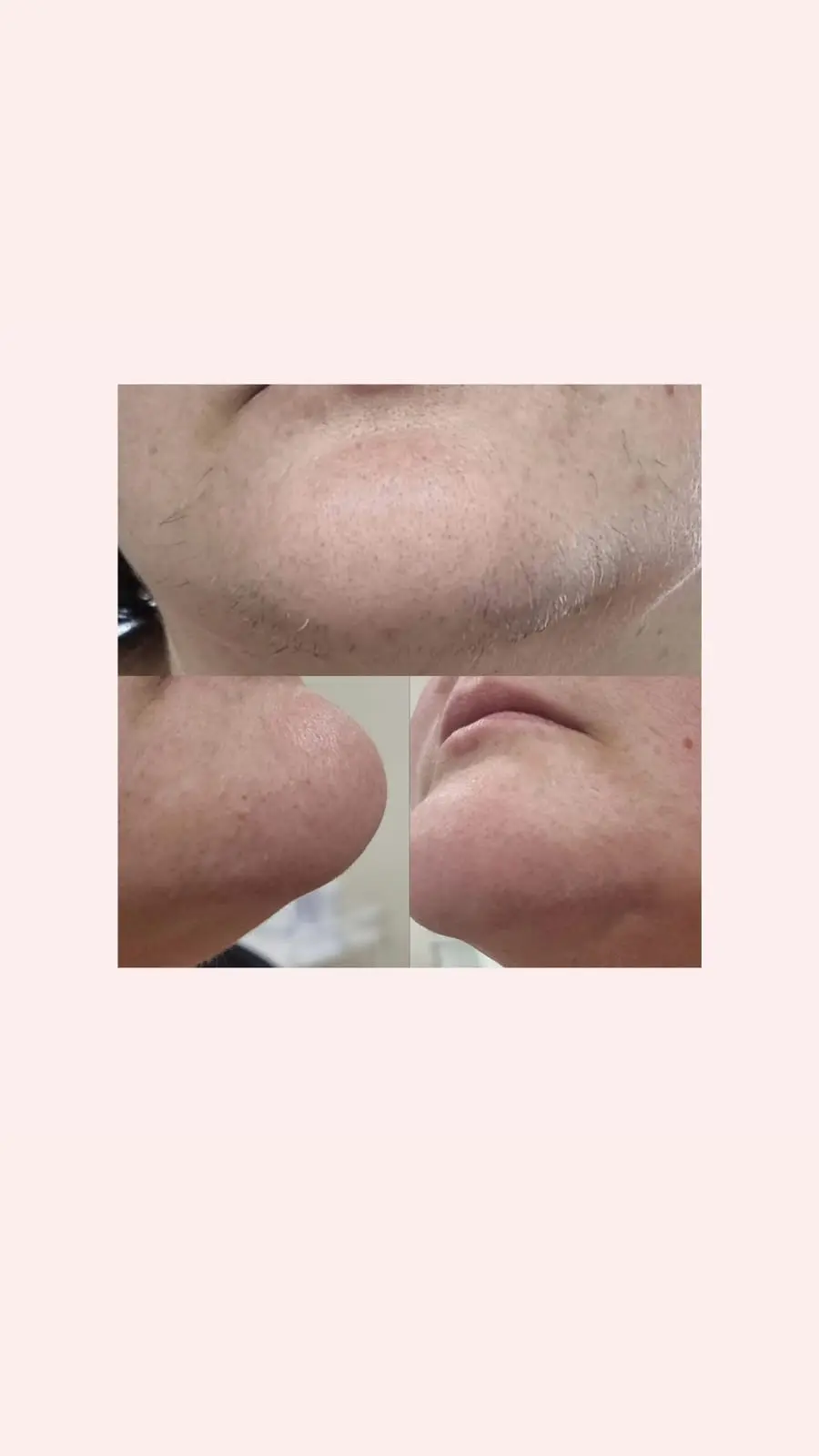 SHR facial hair removal results